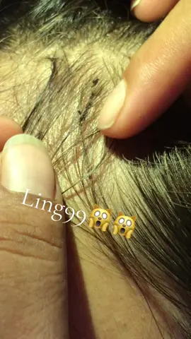 kill lice in one place#omg🙀🙀😛😛 #lice #liceremoval 