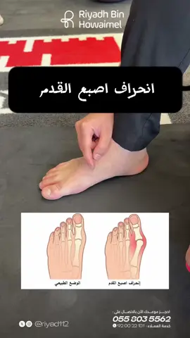 تمارين بتساعد في تخفيف الم انحراف اصبع القدم #علاج_طبيعي #تأهيل #تمارين #صحة #الرياض #تنس #بادل 