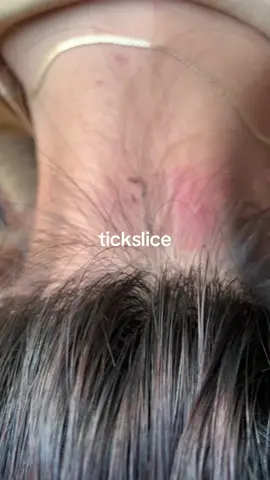 #removalice #omg #tiktokindia_ #lice 