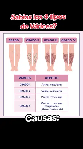 Tienes várices? Que tipo de várices? #varicesyarañitas #varices #varicesenlaspiernas #saludintegral #savitsaludvital  #prevención #tiposdevarices 