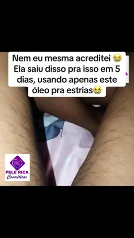 #estrias #testemunhosprodutosdapele #cuidadoscomapele #pelerrica 
