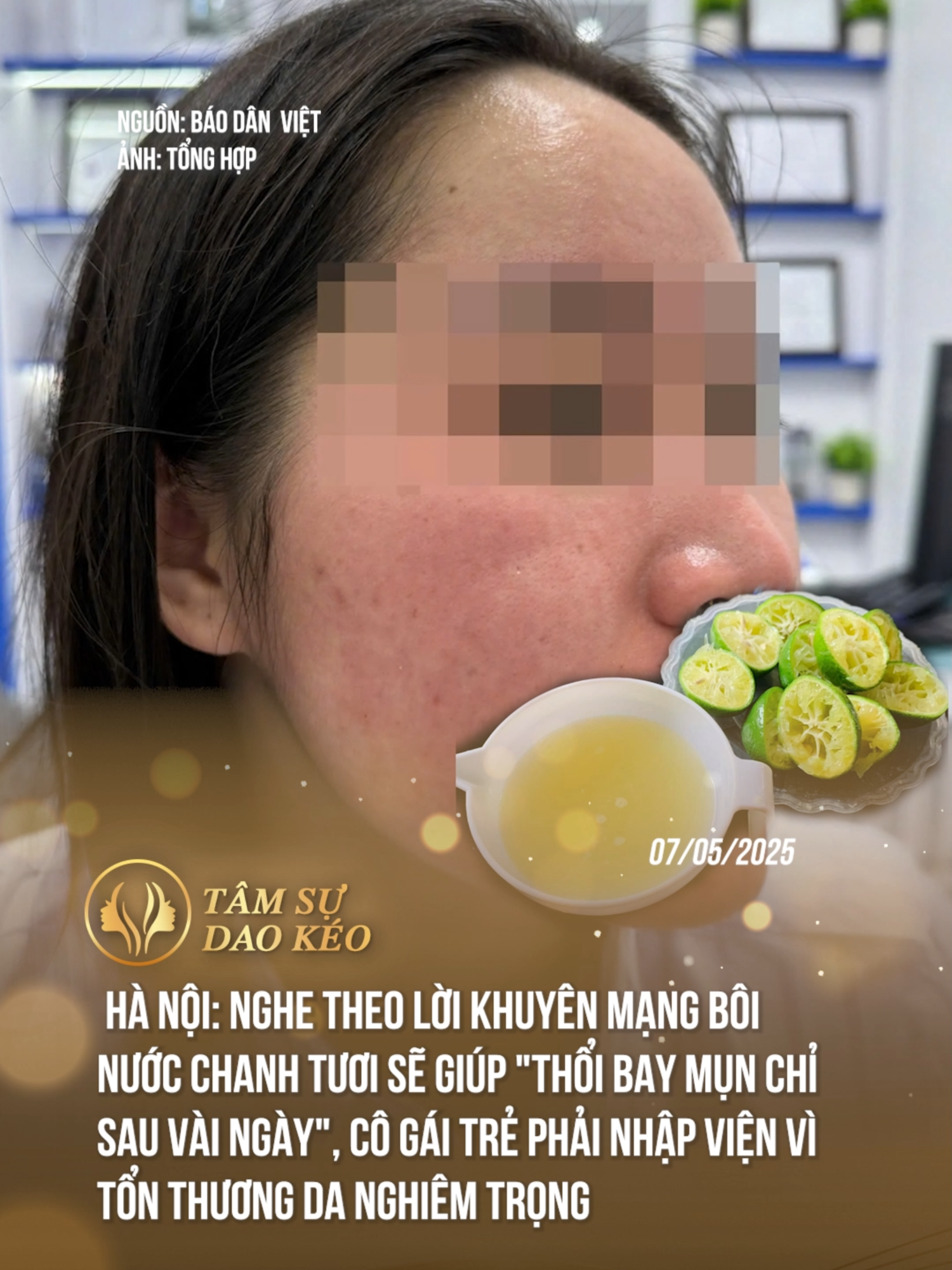 Cảnh báo cho chị em nào đang có ý định chữa mụn bằng chanh nhé, làm theo trên mạng mà không tìm hiểu kỹ thì dễ toang lắm #theanh28 #tamsudaokeo #sacdep #thammy