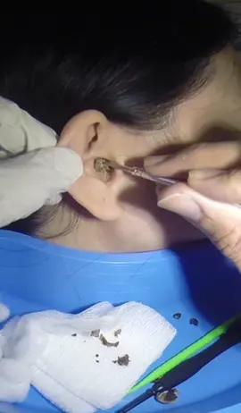 This is Massive! #earwax #earwaxremoval #earcleaning #earpick #fyp #earwaxremovalvideo #earwaxvideo
