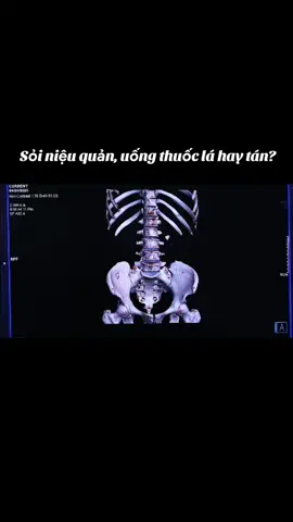 Bạn có từng bị sỏi thận, sỏi niệu quản, bạn tán sỏi hay dùng th.uốc nam, th.uốc tây?  #ct #mri #suckhoe #suckhoelavang 
