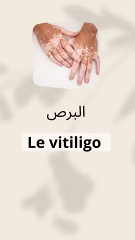 الصلع الثعلبة الصدفية البرص بالفرنسية #calvitie #psoriasis #vitiligogirl 