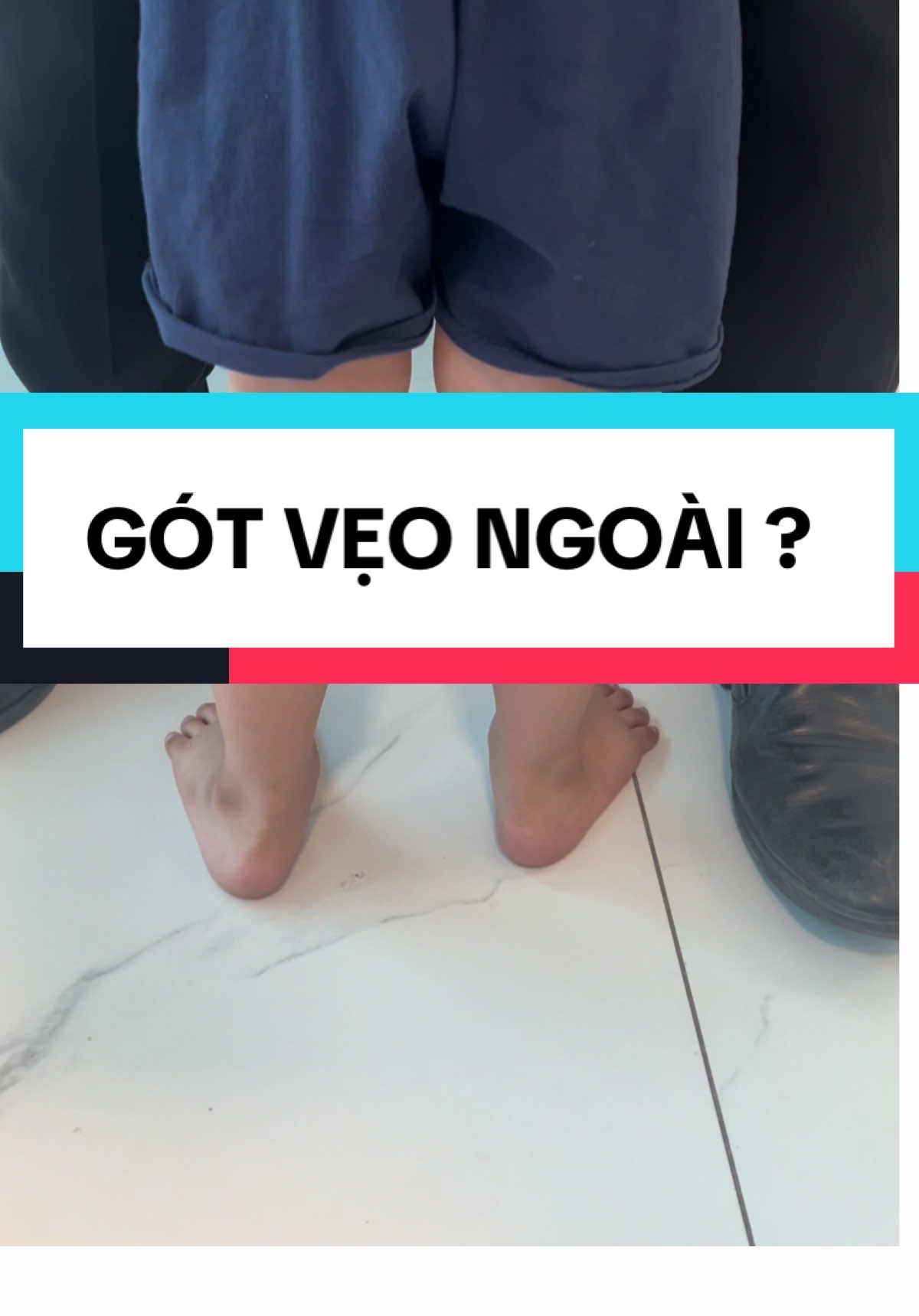 Giải thích về gót vẹo ngoài + chân bẹt mềm #banchanbet #lotgiaychinhhinh #lotgiaycaosunon #ditatbamsinh #benhviennhidongthanhpho #benhviennhihanoi #benhviennhitrunguong 