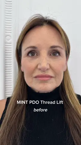Unlock the secret to a youthful, sculpted appearance with MINT PDO thread lift treatments at Harley Street Injectables.  MINT PDO thread lift is a revolutionary non-surgical procedure that utilizes absorbable PDO (polydioxanone) threads to lift and tighten sagging skin, resulting in a more youthful and rejuvenated appearance. Unlike traditional facelift surgery, MINT PDO thread lift treatments require minimal downtime and offer natural-looking results without the risks associated with surgery. Whether you're seeking to revitalize your face, eyes, lips, or body, our advanced procedures are meticulously designed to restore your confidence and redefine your silhouette. Book a consultation: 👩‍💻www.harleystreetinjectables.com 📧 Email us directly: info@harleystreetinjectables.com ⭐️ 5-star google reviews 📍106 Harley Street, Marylebone London #harleystreet #harleystreetinjectables #cosmeticinjectables #mintpdothreads #threadlift 