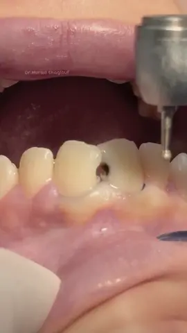 Composite restoration for anterior teeth #dentist #dental #dentistry 