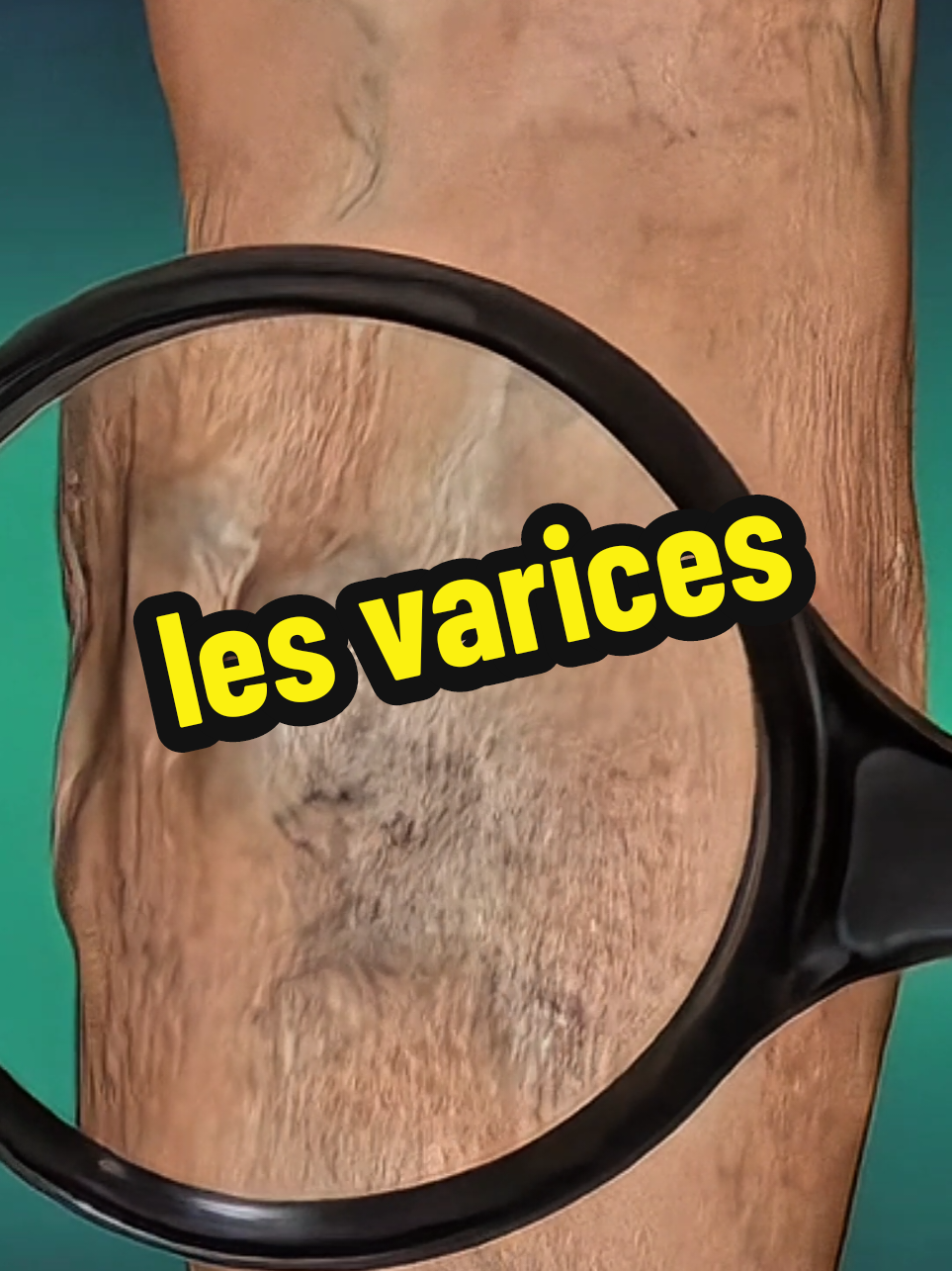 Une varice est une dilatation anormale d'une veine. Au niveau des membres inférieurs, les varices sont visibles sous la peau. De nombreux facteurs héréditaires ou liés au mode de vie les favorisent. La prise en charge médicale prévient la survenue de complications (rupture, thrombose, dermite...) #varices #vascular #medical #fyppp #viralvideos 