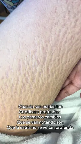 Como siempre les digo lo que se puede ir logrando son avances en la piel , mejoras progresivas.  Les recuerdo que estamos tratando cicatrices no esperen un trabajo rápido y mágico la pi necesita ser tratada y necesita cuidados posteriores !  #inducciondecolageno #induccionpercutaneadecolageno #tratamientoparaestrias #estrias #postpartum #postparto #embarazo 
