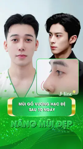 Check form mũi gồ Douyin Vương Hạc Đệ của @Zikey ( Nhân Nguyễn ) sau 10 ngày #jlinekorea #nangmuitrunghoa #phauthuatthammy #nangmuicautruc #douyin #xuhuong #lamdep 