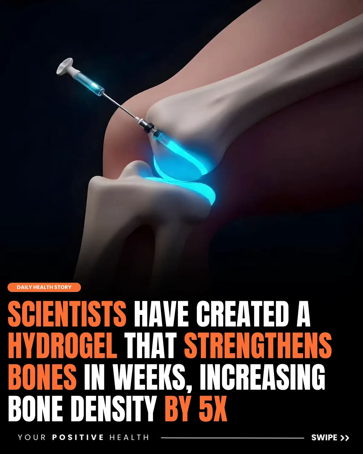 A new injectable hydrogel may soon offer a faster, more effective treatment for osteoporosis. Developed by EPFL researchers and startup Flowbone, the gel uses hyaluronic acid and hydroxyapatite nanoparticles to mimic bone minerals and strengthen weak areas.  Though not permanent, it could revolutionize treatment by speeding up recovery and reducing fracture risk. Clinical trials are the next step. Credit/: GulfInsider