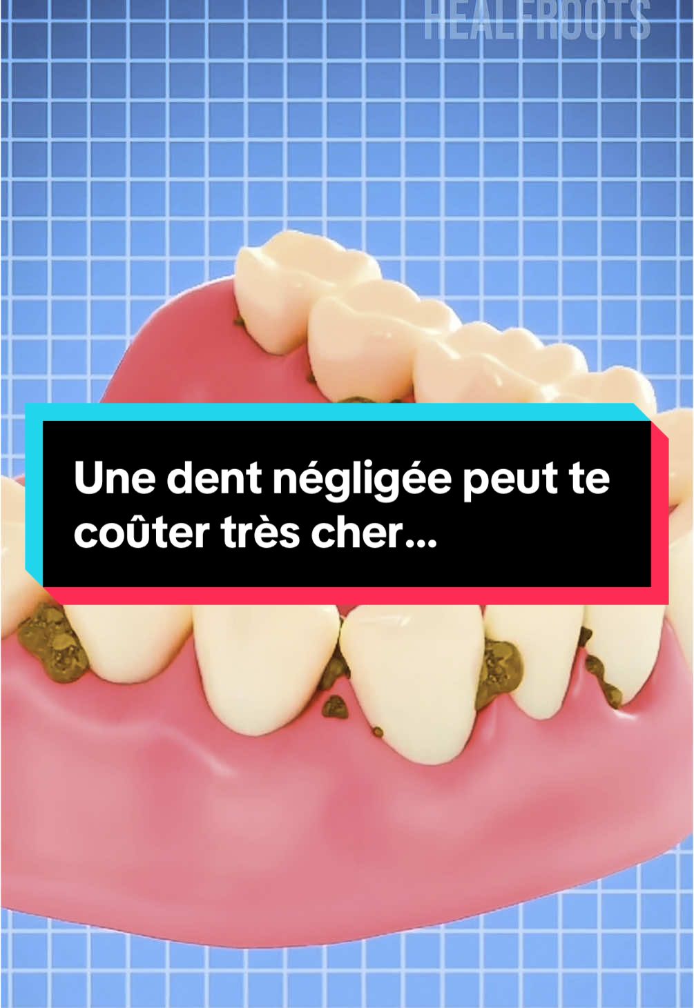 Tu penses qu’une dent abîmée, c’est rien ? ❌ Ce que tu vas apprendre peut littéralement te sauver la vie. Infection, cœur, cerveau… les conséquences sont bien réelles. Fais attention à ta santé bucco-dentaire. Un fait réel que tout le monde devrait connaître.