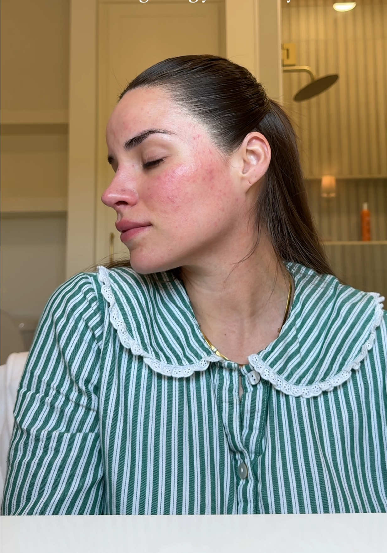 I miss my old skin, but this is my reality now. I was filming a get ready with me, which I never got to finish because I couldn’t help but cry while I looked in the mirror. I wake up every morning hoping it would magically disappear. Somedays I don’t feel like going out for the same reasons, it’s been messing with my confidence and pregnancy has not been it 😭  #skin #skinissues #rosacea #rosaceaskin #skincare  