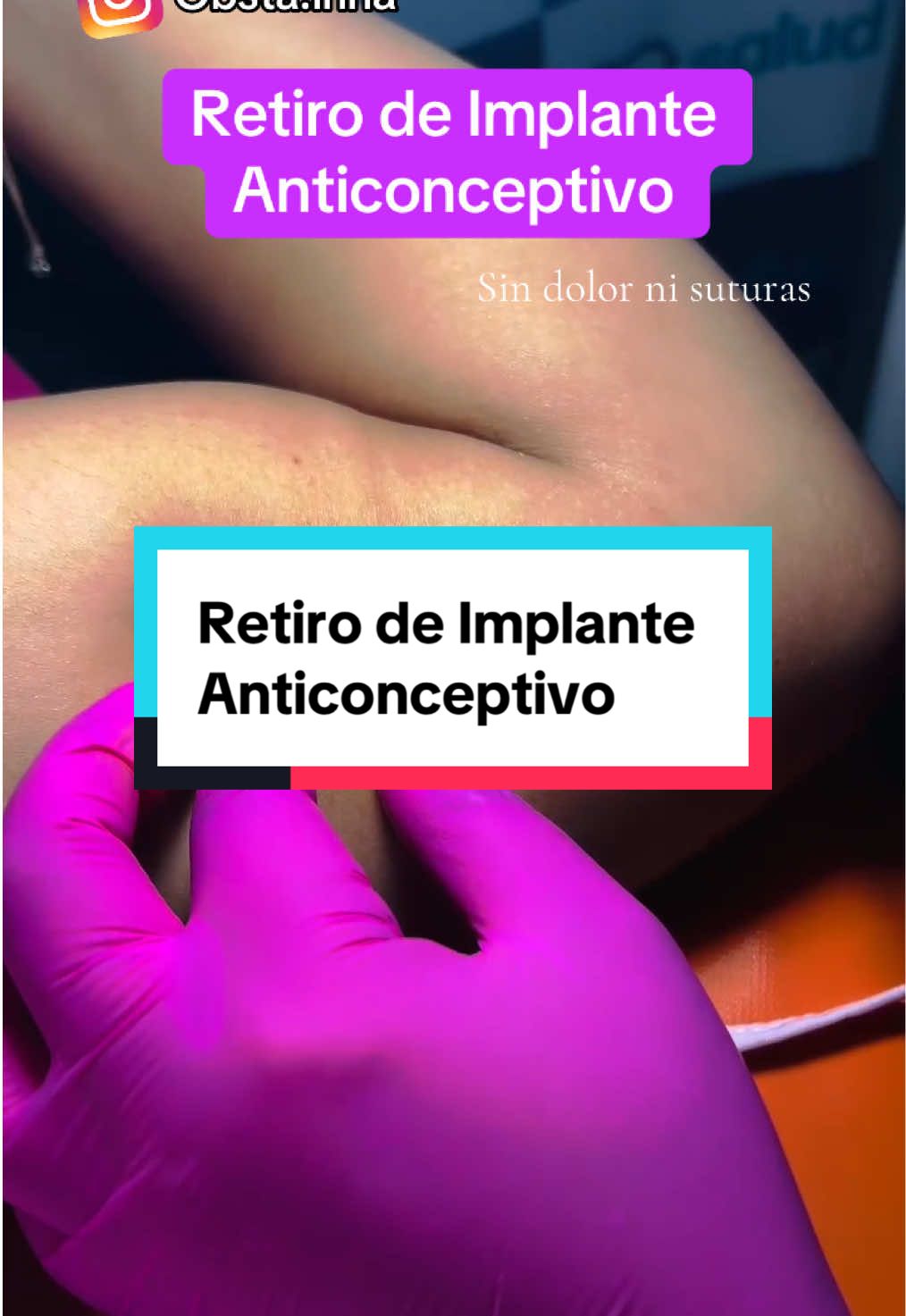 Retiro de Implante Anticonceptivo 👩🏻‍⚕️ #nexplanon #jadelle #implanteanticonceptivo #anticonceptivo #fyp #obstetricia 