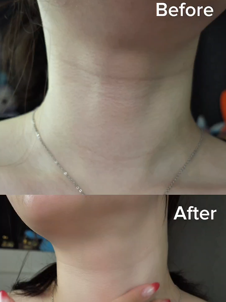 Neck Wrinkles? Retinol Cream Saved My Skin! ✨️ #retinol #neckwrinkles #retinolcream #antiaging #skincareover30 #neckcare #skincaretips #glowingskin #beforeandafter #retinolresults