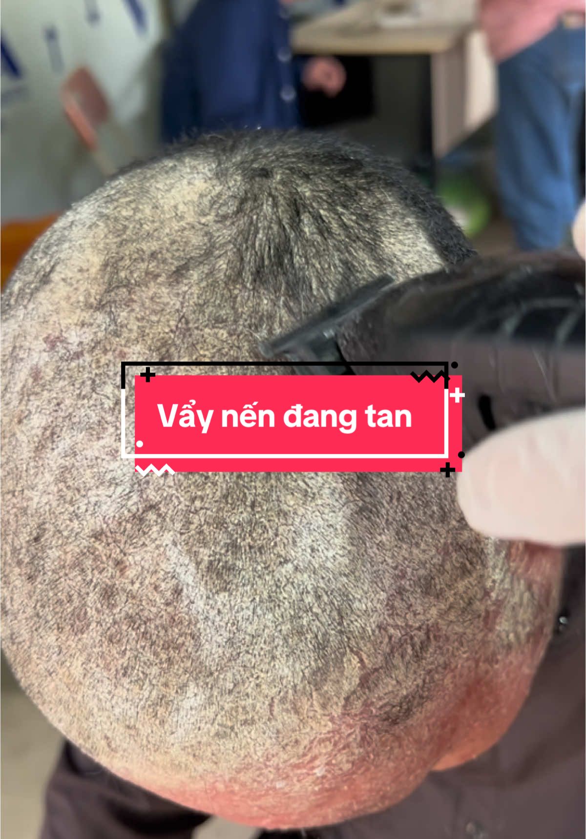 Vẩy nến tan đỡ rồi,mừng vuii lây các bác ạ @Thị Tuyến DC 35(2) #vẩynến #viêmdacơđịa #viêmdatiếtbã 