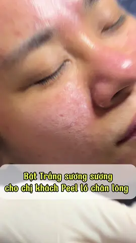 Bật trắng sương sương cho nền da Peel Lổ chân lông vừa xong#kbeautyspa #xuhuong2025 #skicarekhoahoc #chemicalpeel 
