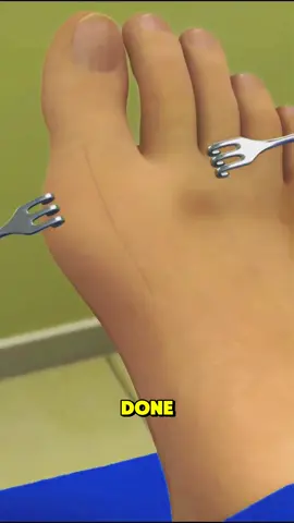 Bunionectomy or Bunion Surgery  #surgery #bunion #bunionectomy #bunionectomyrecovery #bunionectomia #bunionsurgery #bunionectomie #bunionectomyprocedure #bunionectomysurgery #bunionectomyrepair 