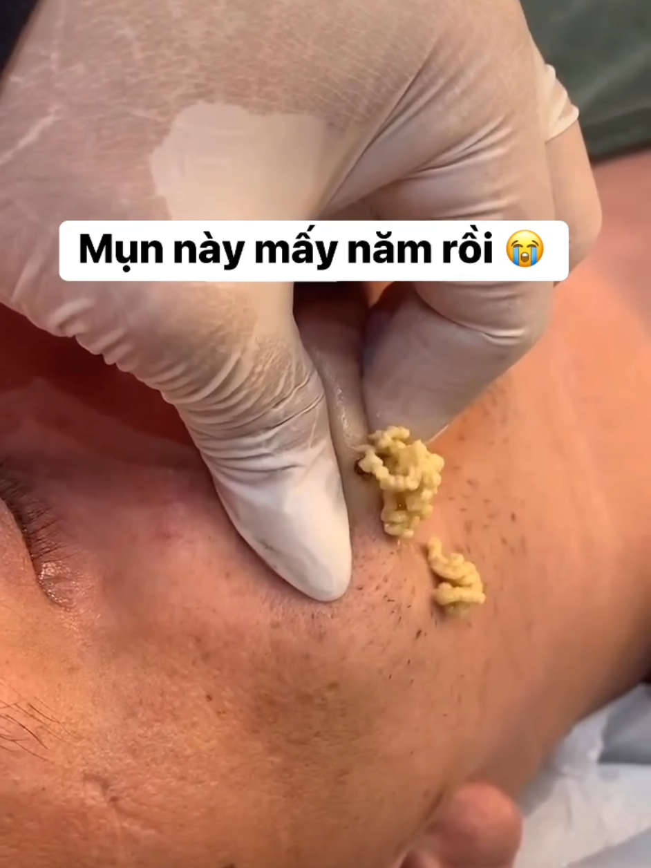 Có ai ghiền coi nặn mụn hông??? #nanmun #face #lenxuhuong #trending #fyppppppppppppppppppppppp 