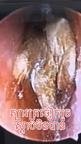 #Telegram089590007 #ត្រចៀក #ច្រមុះ #បំពង់ក #fyp #capcut #trending 