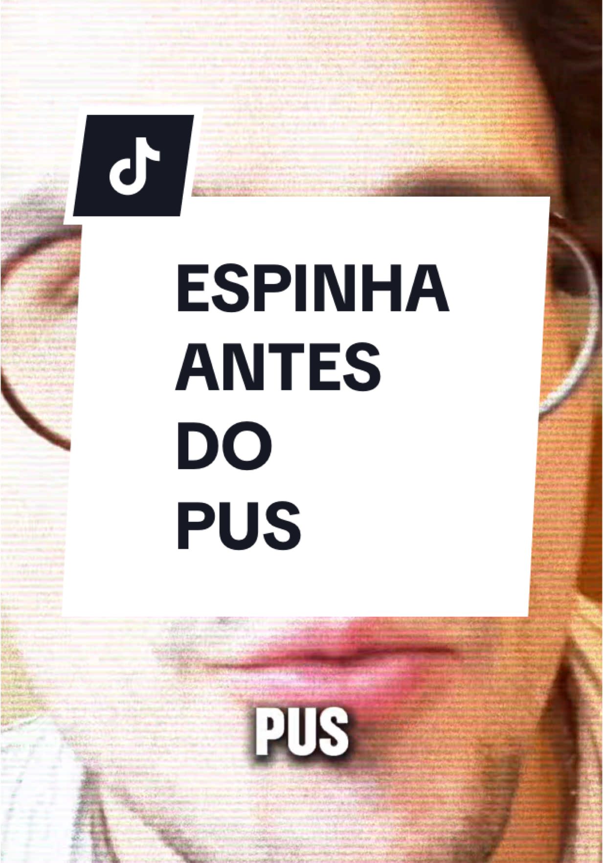A inflamação da espinha começa MUITO antes do pus aparecer. Muita gente ignora o primeiro sinal: a dor ao toque. Essa é a hora certa de agir — antes da espinha virar um vulcão. Nesse vídeo eu explico o que acontece por dentro da pele, e quais ativos realmente funcionam pra conter essa inflamação. Salva esse vídeo pra lembrar quando a próxima espinha ameaçar nascer. E me conta: você já sentiu dor antes da espinha aparecer? #dermatologia #acneinflamatória #cuidadoscomapele #espinha #skincaredermatológico #drivansilva #pelebonita #dermatoportoalegre