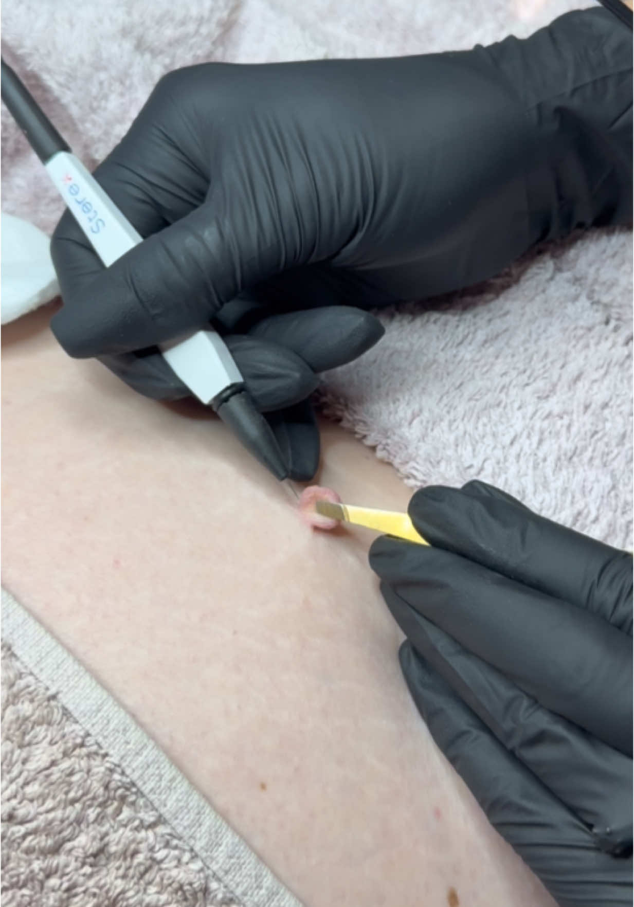 Removing a large skin tag using advanced electrolysis Got a large or stubborn skin tag you want gone? We offer professional, safe removal right here in Kettering. For professionals: If you’re a Blemish Pro member, I’ll be sharing the full breakdown of this treatment in June’s content bundle — including which probe I used, the settings, and my step-by-step approach for the best results. And if you’re looking to train in advanced cosmetic procedures, I also offer CPD-accredited training for anyone with a Level 3 NVQ in Beauty Therapy and A&P. Step into confidence with support, knowledge, and practical guidance — we’ve got you covered. #skintagremoval #electrolysis #blemishremoval #ketteringbeauty #blemishpro #advancedelectrolysis #beautytraining #cpdaccredited #skintreatment @sterex 