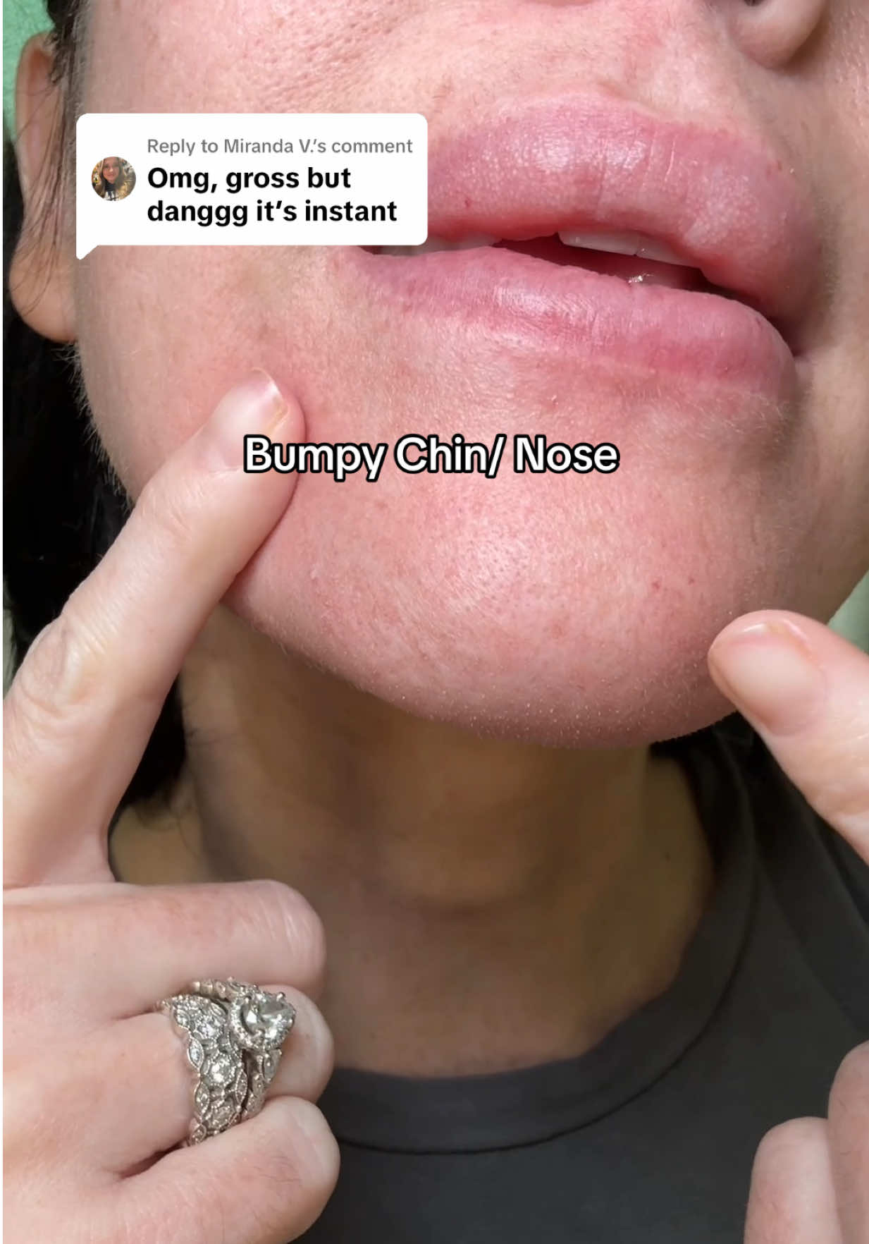 Replying to @Miranda V.  In K beauty skincare we trust 🤲🫰🏼 #drmelaxin #peelshot #riceexfoliator #koreanbeauty #kbeauty #poreminimizer #skinexfoliation 