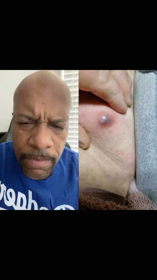#duet with @#1 Nasty Pops and Extractions #fyp #xyzbca #howbizarre #tiktok #funny #oilyfans 