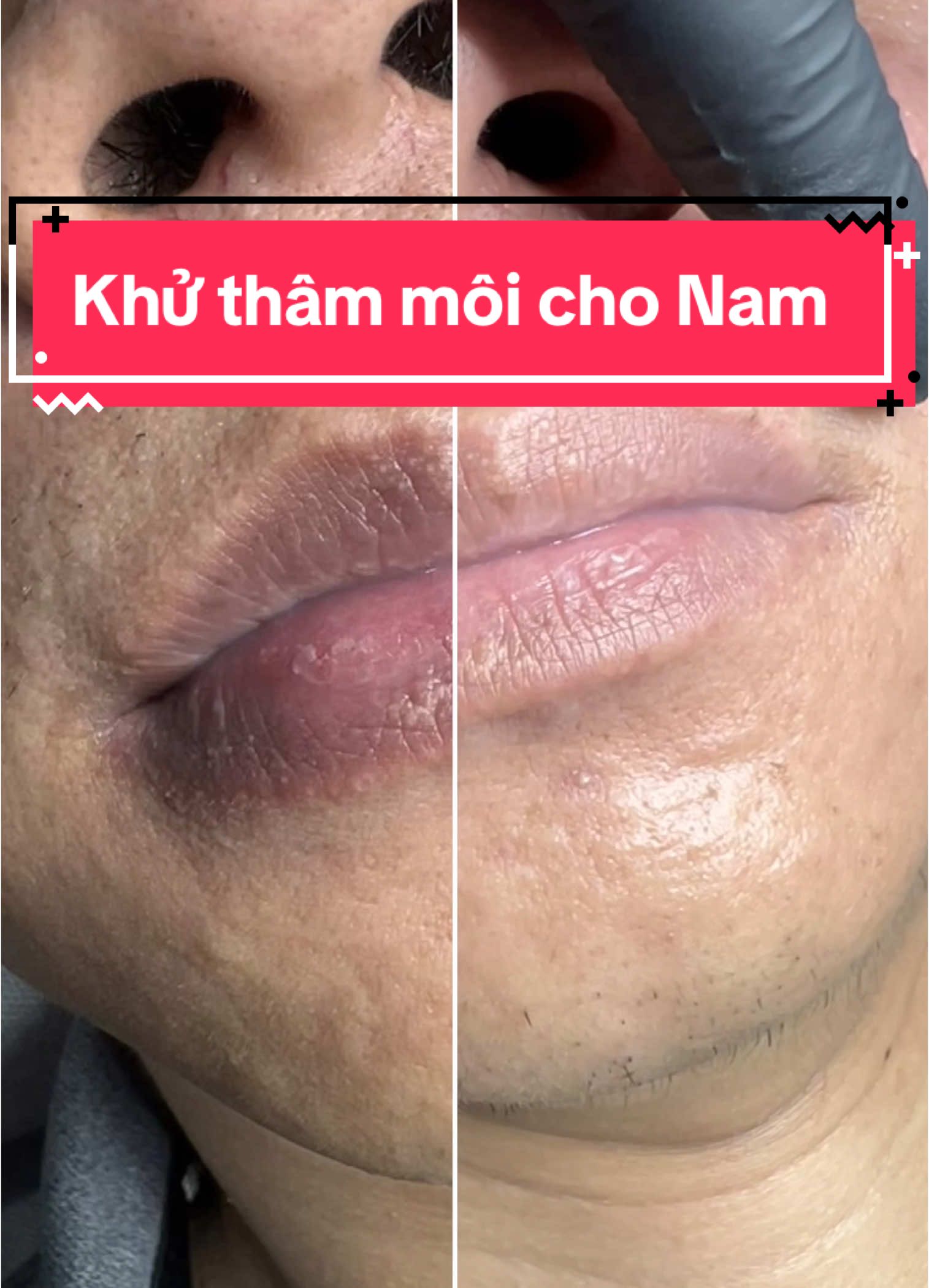 Khử thâm môi cho nam – chuẩn tự nhiên, không lộ dấu vết! Đẹp là quyền lợi của tất cả, kể cả các anh!” #PhunXămMôiNam #KhửThâmMôiNam #MôiChuẩnNamTính #BeautyForMen   #ĐẹpChuẩnTựNhiên #XửLýThâmMôi #XuHướng2025 #TikTokBeauty #ViralTikTok  