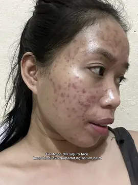Grabe talaga pinagdaanan ko bad acne break out. Halos umiyak ako gabi gabi at hiyang hiya humarap sa tao dahil sa naiwang dark spots and Post inflammatory erythema. Buti unti unti nawala. Kaya girls wag kayo pang hinaan ng loob kaya natin to ✨✨ #acne #acnetreatment #acnedarkspots #postinflammatoryerythema #skincare #skincareforacne #serumforacne #moisturizerforacne 
