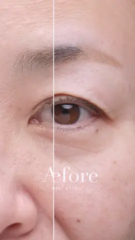 #眼瞼下垂手術 #表ハムラ 