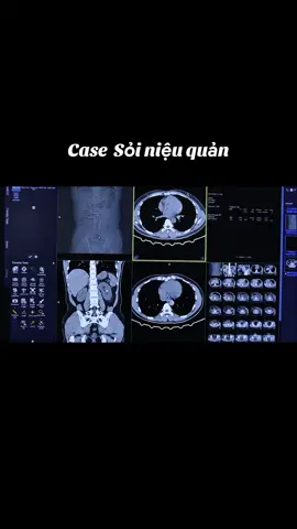Case Sỏi niệu quản. Nguyên nhân gây đau của bệnh nhân, chụp cắt lớp vi tính CT.  #ct #mri #suckhoe #suckhoelavang 