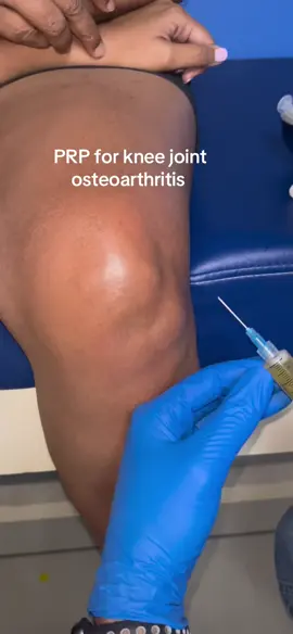 PRP for knee joint osteoarthritis  #plateletrichplasma #osteoarthritis #rheumatoidarthritis #move #repair #regenerate 