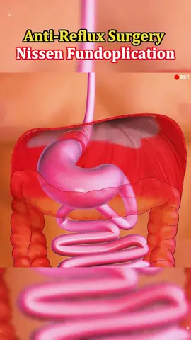 When acid reflux won’t quit… this surgery might be the answer. ?? #medicalmagic #GERD #surgeryexplained #chronicacidreflux #medicalanimation #doctorreact #hiddensisability #antireflux 