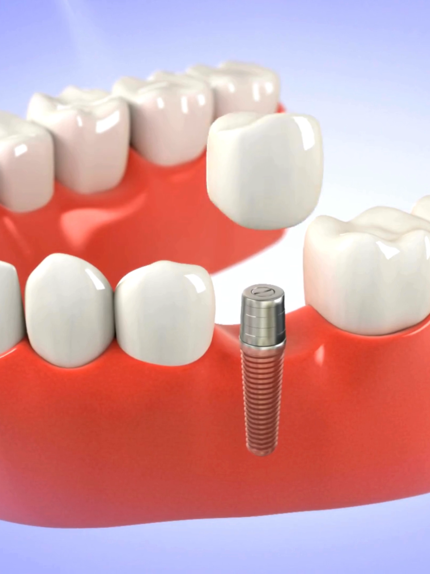 🦷✨ Ever wonder how a dental implant actually works? Our animated video breaks it down step by step — no drills, just easy visuals! 🎬😄 It’s the perfect way to see how we bring back confident smiles, one implant at a time.  💬 Dental Implants starting from £2600 📍 U’r Smile Dental & Aesthetic – Expert care, modern solutions, and smiles that last!  📞 For Appointments: 0118 327 4355 📧 Email: contact@ursmile.co.uk 🌐 Website: www.ursmile.co.uk 📍 Address: 258 Kentwood Hill, Reading, England RG31 6DR #dentalimplants #toothtalk #smilejourney #implant #healthysmiles #dentalcareuk #readingdentist #oralhealthmatters #ursmile #dentalcare