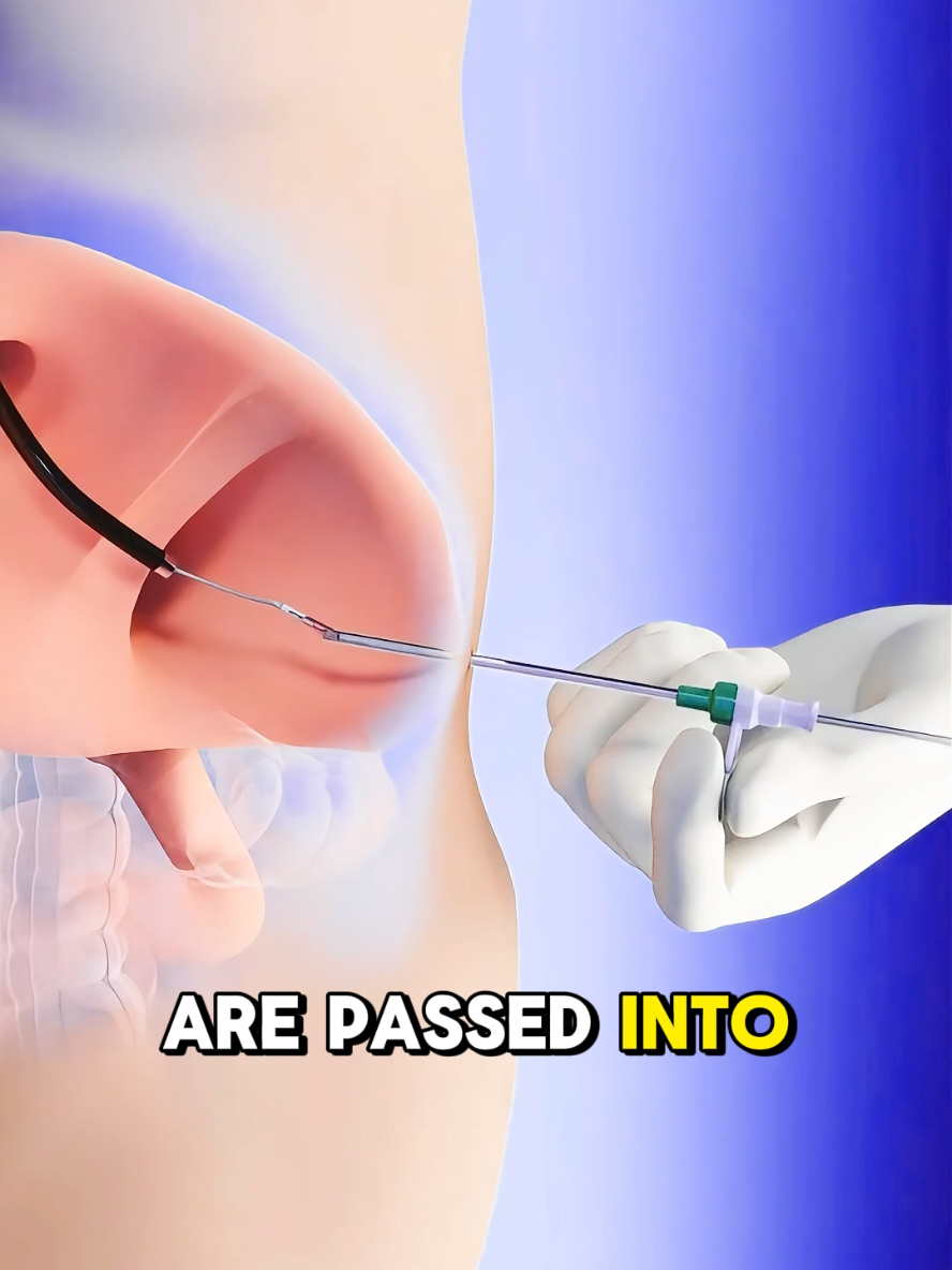 Percutaneous Endoscopic Gastrostomy(PEG) Procedure (3D Animation) #percutaneous #endoscopic #endoscopy #endoscopytech #gastrostomy #procedure #medical3danimation #3dmedicalanimation 
