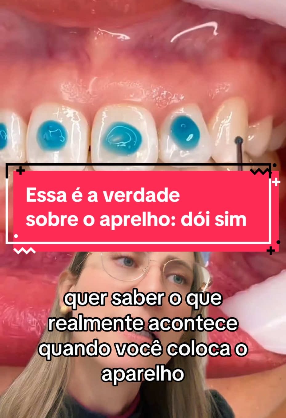 Aparelho ortodôntico dói? A verdade que ninguém te conta (e eu vou te explicar agora!) ⬇️ Leia isso antes de colocar o seu aparelho! Quando você coloca o aparelho, o fio ortodôntico começa a aplicar uma pressão leve nos dentes. Essa pressão movimenta os dentes e o osso ao redor se adapta — e é aí que você sente aquele incômodo. ⚡️ Mas calma: — Não é uma dor insuportável! — O desconforto dura só de 2 a 3 dias. — Depois, o seu corpo acostuma rapidinho. Dicas para aliviar o desconforto: ✔️ Coma alimentos moles (purês, sopas, iogurtes) ✔️ Use um analgésico recomendado, se precisar ✔️ Capriche na higiene bucal E o mais importante: não desista! Esse incômodo temporário vale a pena pra você conquistar o sorriso que sempre sonhou. Gostou da dica? Deixa um comentário aqui ou me chama no direct pra agendar sua avaliação! #aparelhoortodontico #sorriso #ortodontia #clinicmais