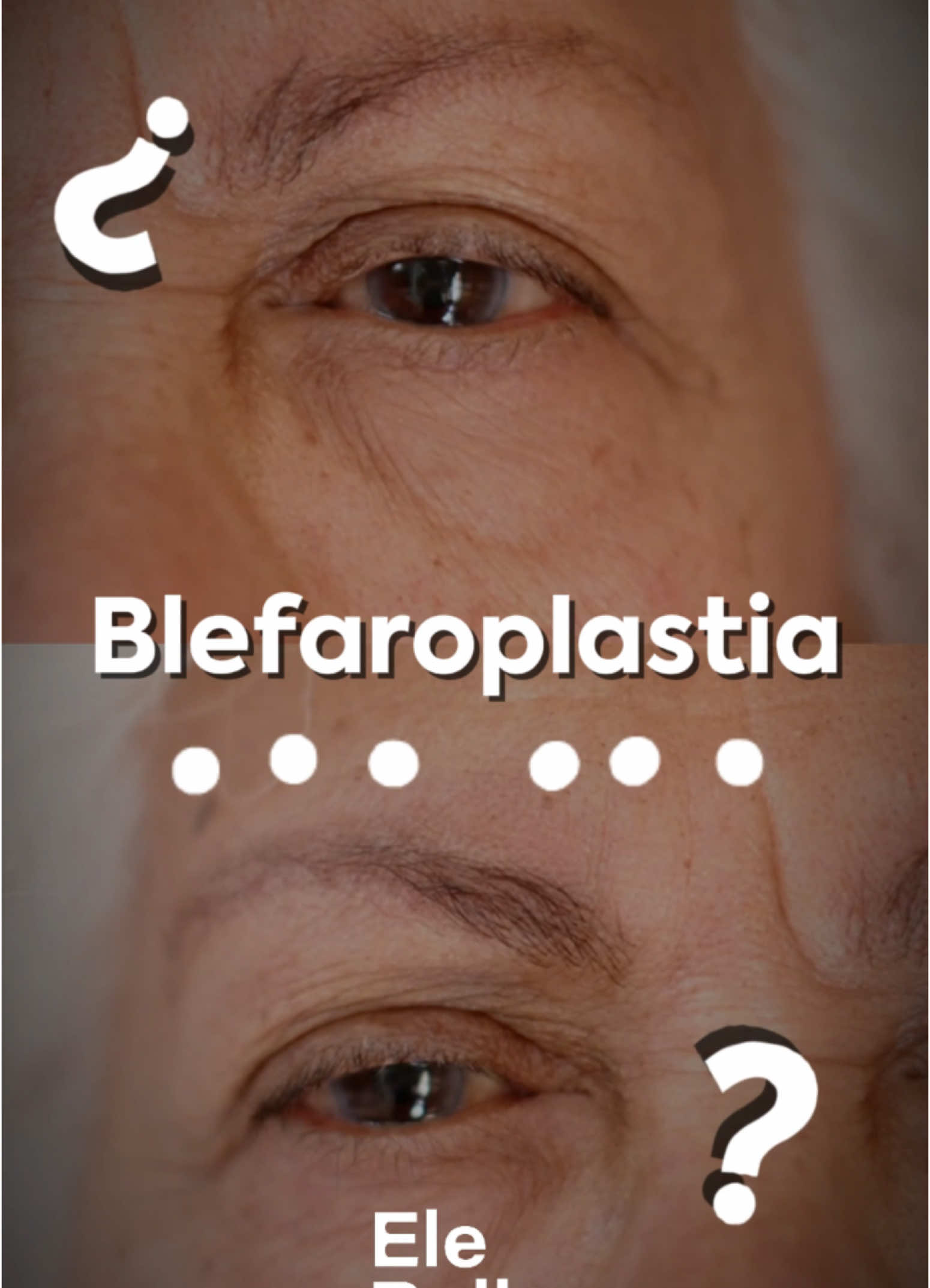¿Te gustaría saber si eres candidata o candidato para esta cirugía?  La blefaroplastia es una cirugía estética que ayuda a rejuvenecer la mirada, eliminando el exceso de piel o bolsas en los párpados superiores e inferiores. Es ideal para quienes desean verse más frescos, con una expresión más ligera y descansada, sin perder naturalidad. Lo mejor: es un procedimiento rápido, con recuperación progresiva y resultados duraderos. Agenda tu cita en Elebelle 😁 #blefaroplastia #tacna #liftingfacial #peru #elebelle