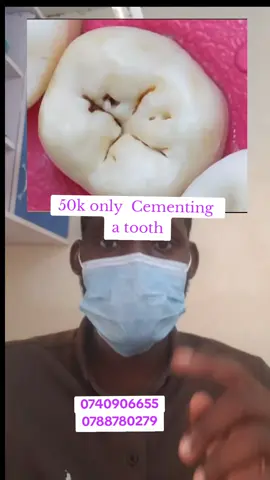 Tooth Cementing made affordable and accessible. Call/text 0740906655, 0788780279. #teeth #teethcare #fyp #uganda #kampala_tiktokers 