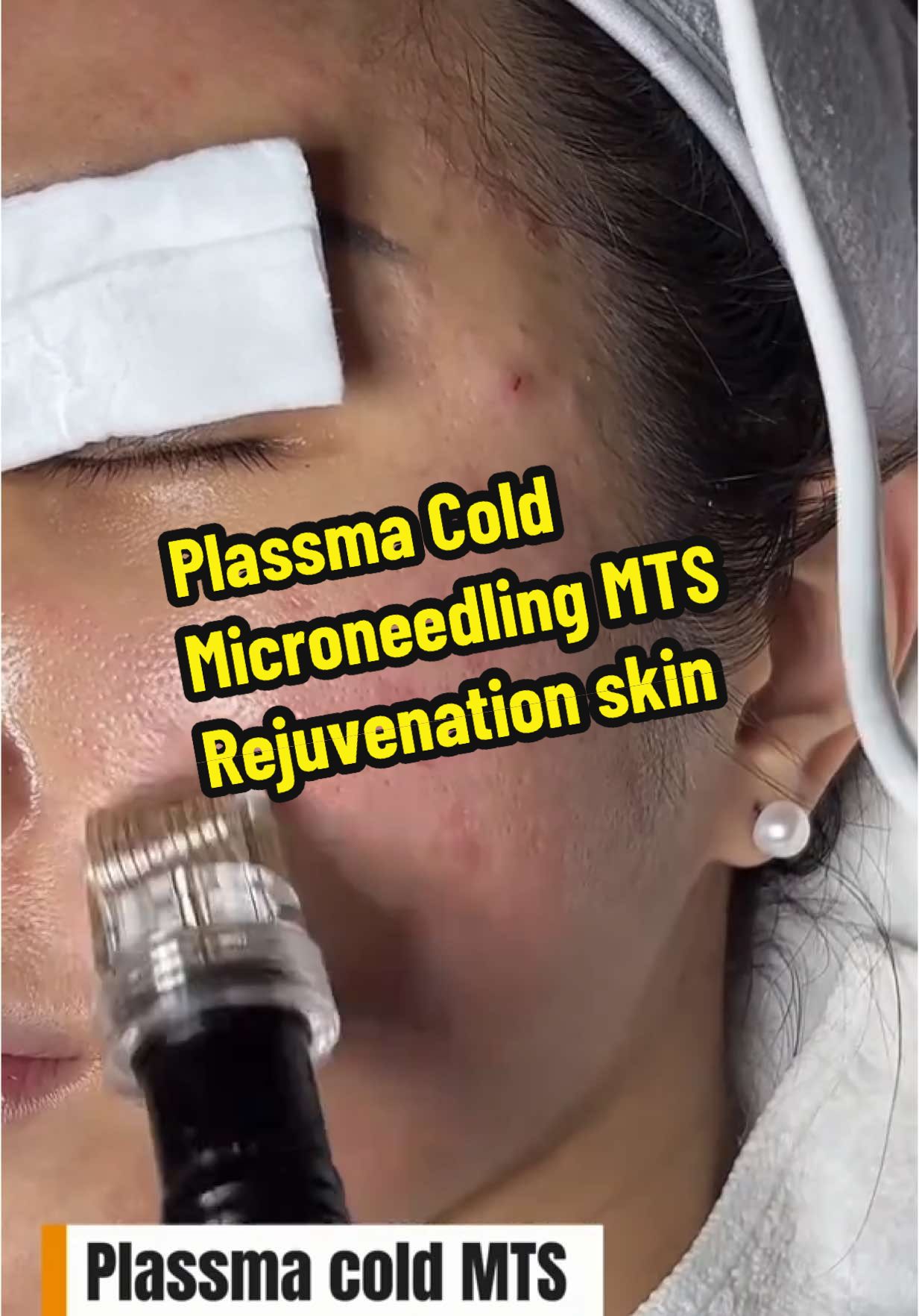 MTS Plasma – advanced micro-needling technology that rejuvenates your skin and minimizes pores effectively! Healthy, glowing, even-toned skin—no filter needed! #tiktoklive #livehighlights #sgbeautyblogger #sgbeautyproducts #acnetreatment #sgskincare #deepscarstreatment #icepickscars #plassmacold #plasmacoldsg #rejuvenation #microneedling #whiteningpeeling 