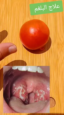 وصفة لعلاج إلتهاب الحلق  #تكال #تبيض_الجسم #algeria #tiktok #المغربيات_اجمل_نساء_الكون #viral #مالي_خلق_احط_هاشتاقات #شعب_الصيني_ماله_حل #trend #fyp #fyp 