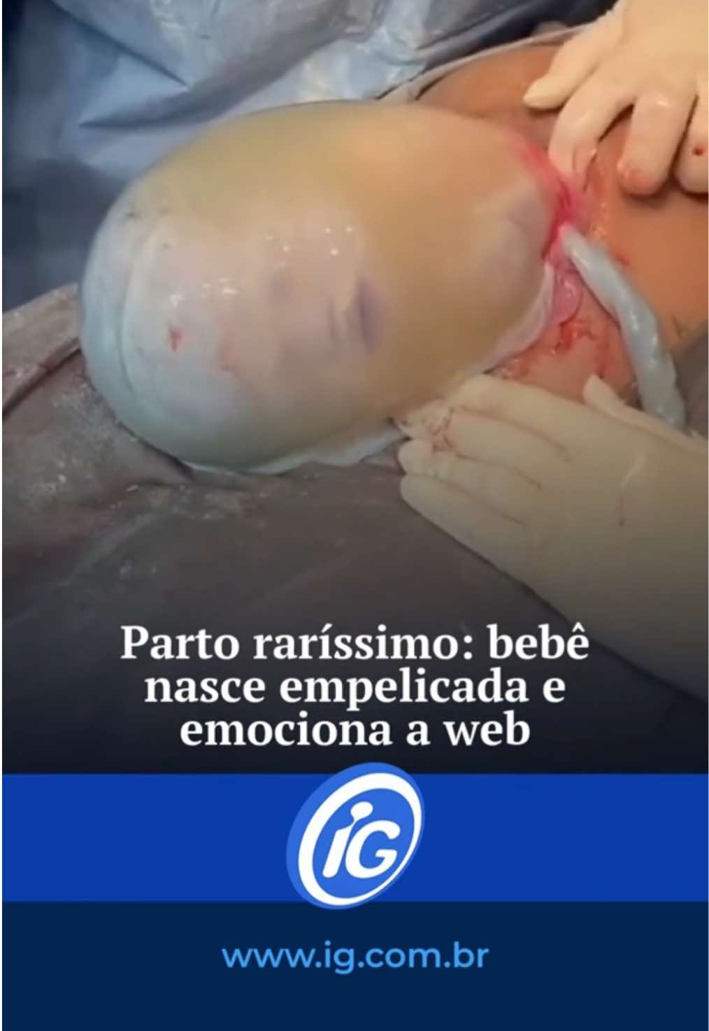 Fofura 👶 😍 Uma cena rara chamou a atenção de internautas recentemente. A pequena Luiza veio ao mundo ainda envolta na bolsa amniótica, um fenômeno incomum conhecido como parto empelicado. O momento foi registrado pela equipe responsável pelo parto da bebê e logo viralizou nas redes sociais. Nos comentários da publicação, internautas demonstraram surpresa e admiração: 💬 