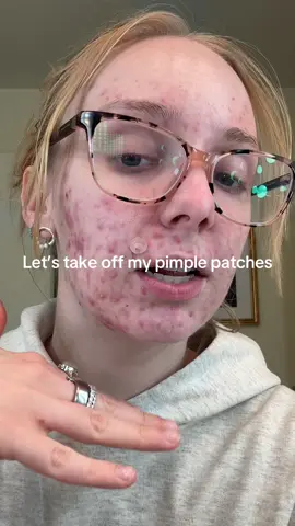 Mind you this was only 10 days ago #acne #pimplepatch #pimplepatches #acnegirly 