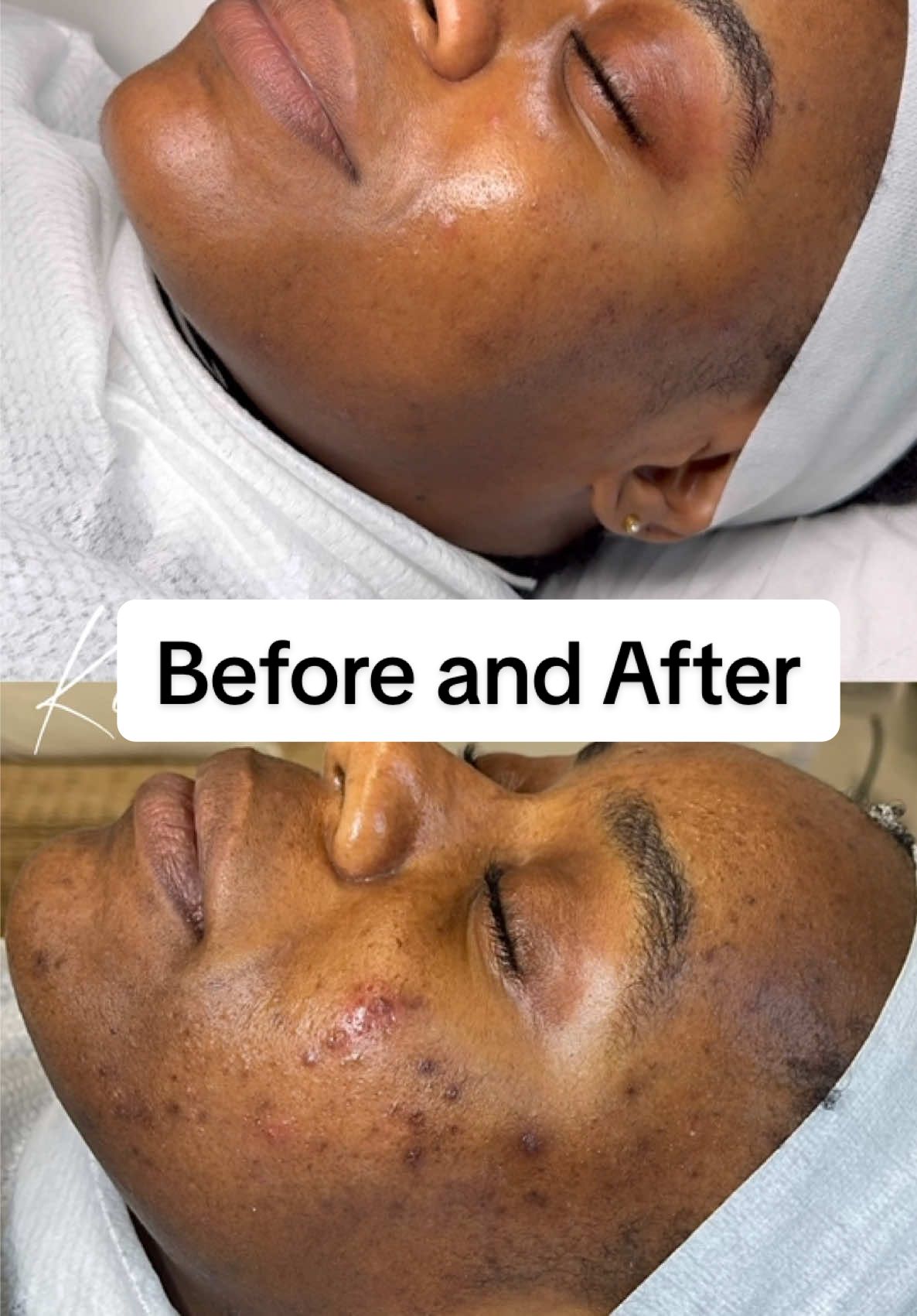 What a transformation 🤩 My beautiful client came in for a new client consultation. A month prior she had a Microneedling facial with someone else. This unfortunately left her with severe contact dermatitis / increased breakouts After the consultation, she was sent home with medical grade products to use whilst her barrier repaired for 2 months. We have performed a range of treatments not just one. This included Acne facials / Microneedling / peels As humans we want results fast, but you have to remember you must improve the health of your skin first before you can treat acne or pigmentation New client appointment needed for all new clients ❤️ #acne #skincare #skintok #pigmentation #hyperpigmentation #microneedling #darkmarks #london #fyp #fy #blackskin #trending