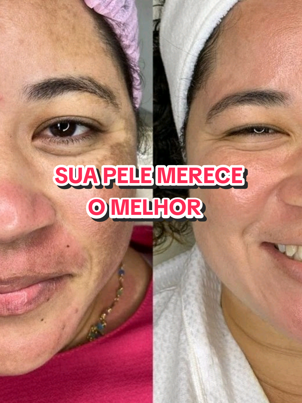 Sua pele merece o melhor — de dentro pra fora. Descubra o poder do Hidra Pele e diga adeus às rugas e linhas de expressão! #HidraPeleOriginal #PeleLindaSempre #VitaminaDaBeleza #CuidadosComAPele #RejuvenescerNaturalmente #HidraPele #SaúdeeBeleza #AdeusRugas #PeleJovem #SemBigodeChinês #PeleRejuvenescida #BelezaDeDentroPraFora #VitaminaParaPele #RostoSemMarcas #AnvisaAprovado