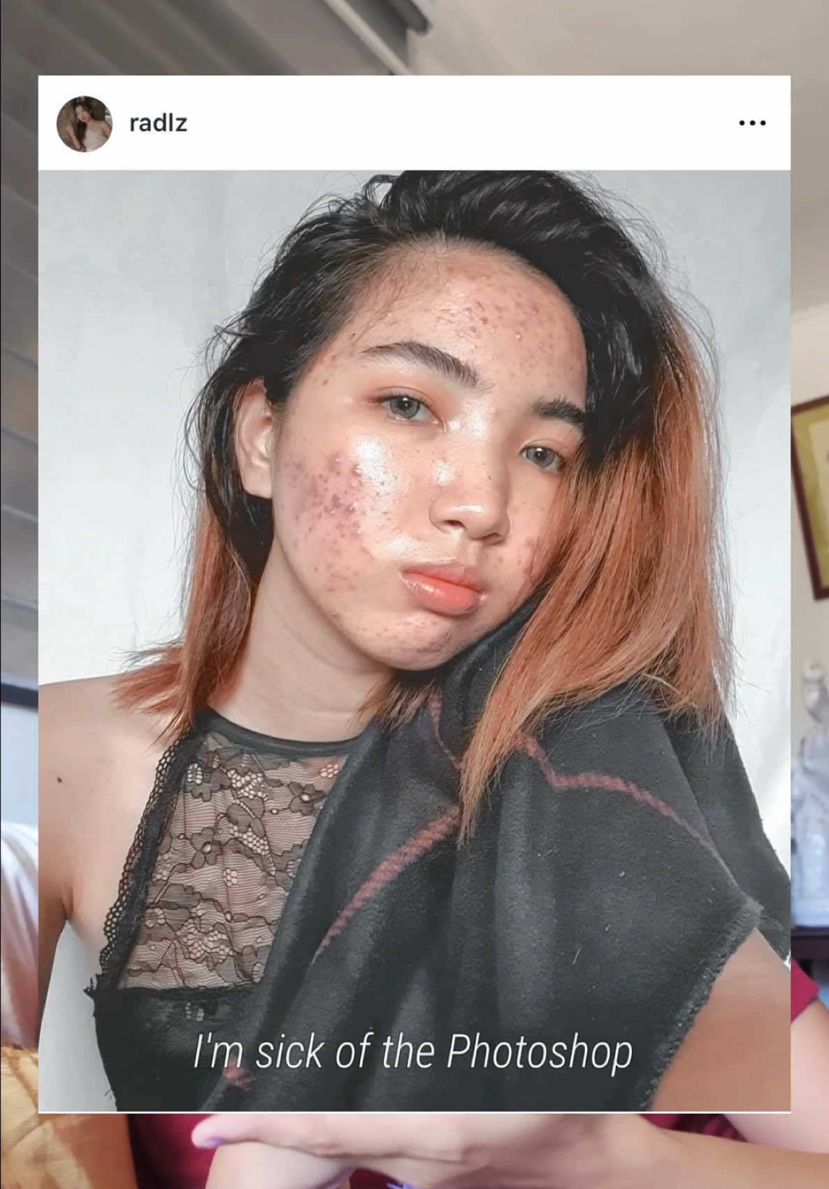 This is how I solved my acne problem of 5 years. #hormonalacne #acnesolutions #clearskin #acnejourney #acneresults 