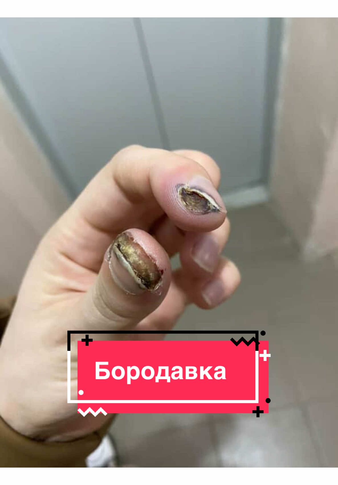 История из практики  #подоблогеркз #подологастана #подологкараганда #бородавка #лазер 