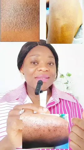 Tu as des petits boutons granuleux sur les bras, cuisses ou fesses ? 😩 Découvre les 2 vraies solutions qui fonctionnent sur peau noire ! 💡👇 #SkinClarity  #bouton #keratosispilaris #keratosepilaire #peaudefraise #routinesoin #skincare #GlowUp #retinol #exfoliation #germany #allemagne🇩🇪 #CapCut #ConSantanderConecto 