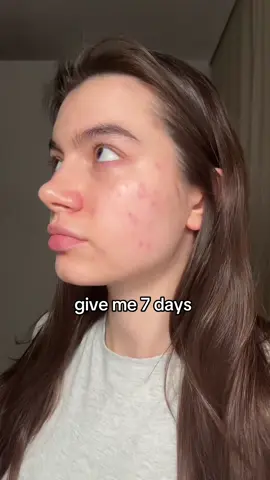 this serum saved my skin several times 🫰🏻  #skincare #skintok #kbeauty #koreanskincare #skincareroutine #7days #retinalserum #acneserum #poreserum #rednessserum #acnefree #clearskin #viralskincare #skincaretips #oliveyoung #serum #pores #acne #retinol #retinal #fyp #fy #glowupwithretinalchallenge #seoul1988 #ksecret  @KSECRET GLOBAL 